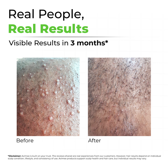 Instant Water Softener for Hair Loss Due to Hard Water